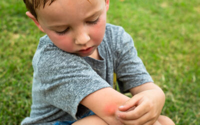 Mosquito Bites in Kids