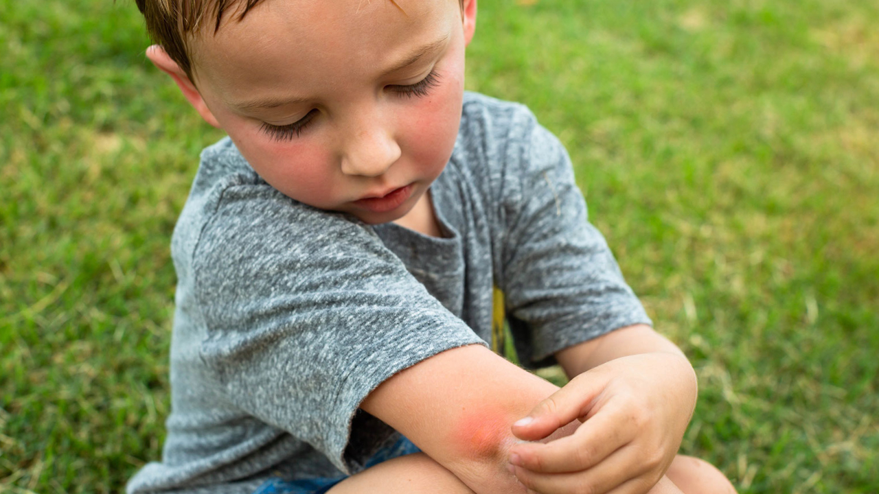 mosquito-bites-in-kids-127-pediatrics