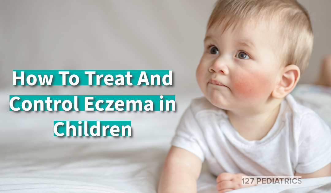 how to treat and control eczema in children